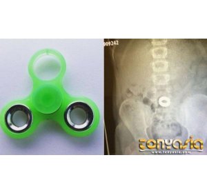 Gadis di Indiana Tersedak Fidget Spinner | Judi Casino Online | Casino Online